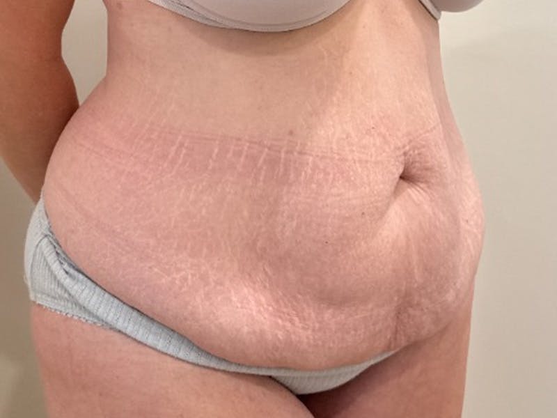 Tummy Tuck Before & After Gallery - Patient 266744 - Image 3
