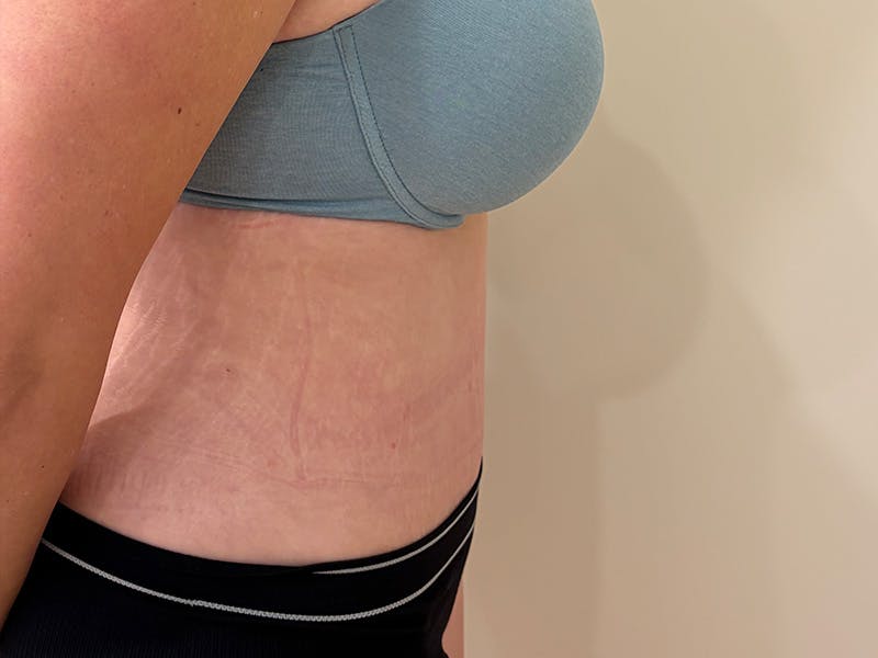 Tummy Tuck Before & After Gallery - Patient 266744 - Image 6