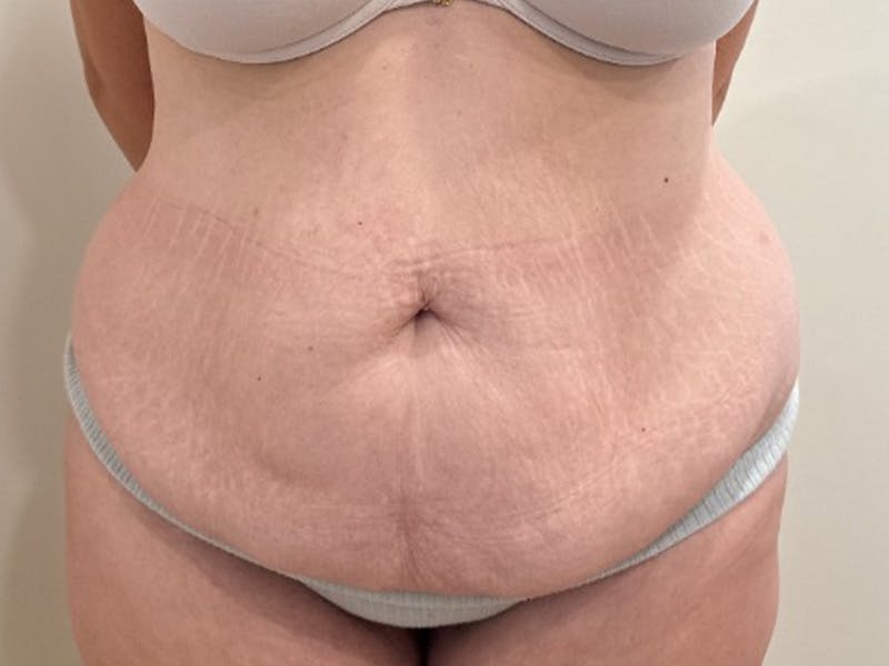 Tummy Tuck Before & After Gallery - Patient 266744 - Image 1