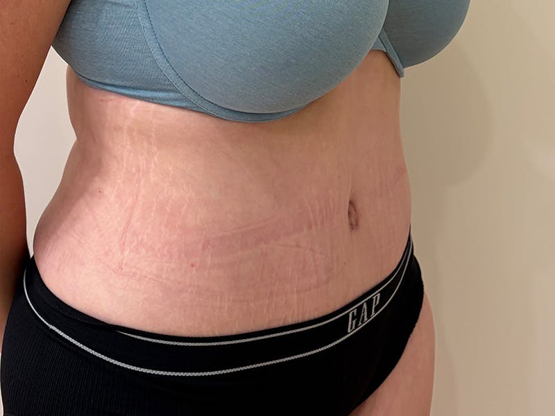 Tummy Tuck Before & After Gallery - Patient 266744 - Image 4