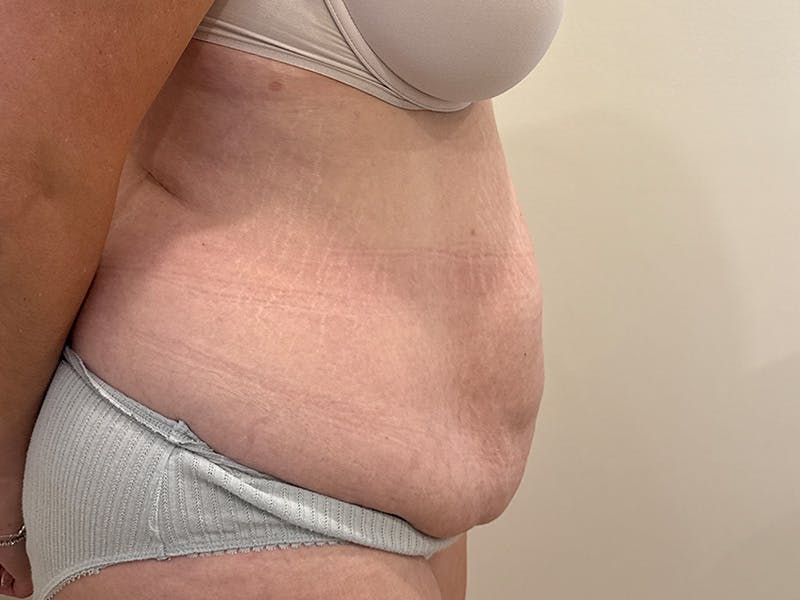 Tummy Tuck Before & After Gallery - Patient 266744 - Image 5
