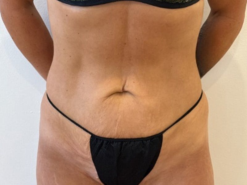Tummy Tuck Before & After Gallery - Patient 121840 - Image 1
