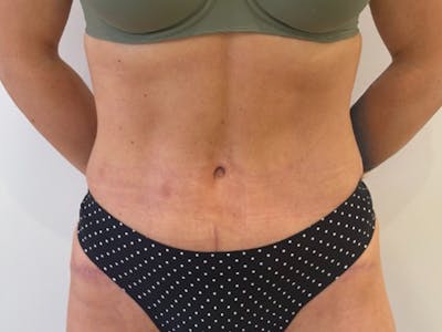 Tummy Tuck Before & After Gallery - Patient 121840 - Image 2