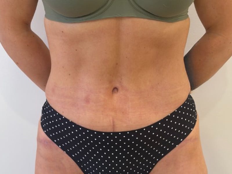 Tummy Tuck Before & After Gallery - Patient 121840 - Image 2