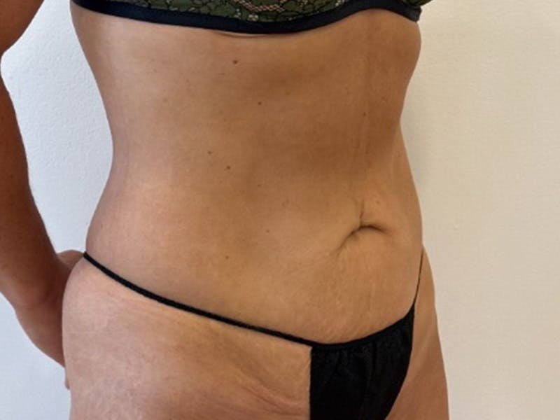 Tummy Tuck Before & After Gallery - Patient 121840 - Image 3