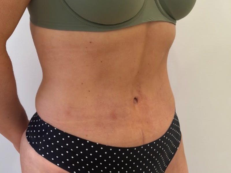 Tummy Tuck Before & After Gallery - Patient 121840 - Image 4