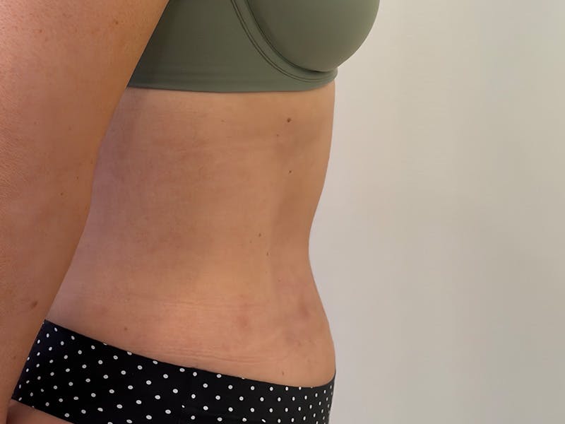 Tummy Tuck Before & After Gallery - Patient 121840 - Image 6