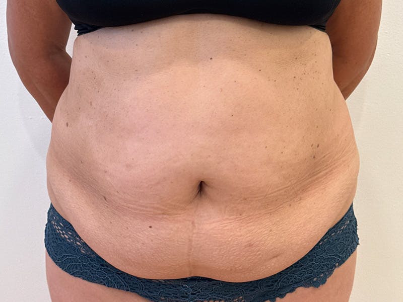Tummy Tuck Before & After Gallery - Patient 103670 - Image 1