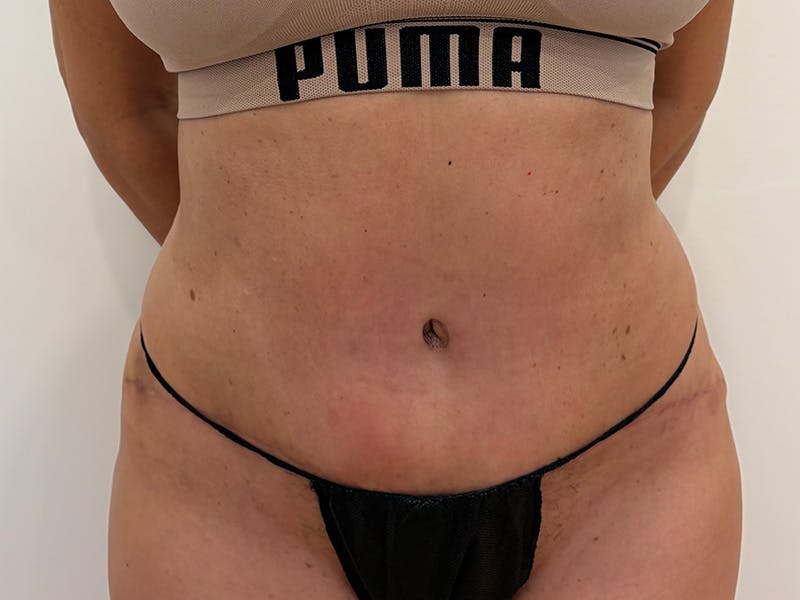 Tummy Tuck Before & After Gallery - Patient 103670 - Image 2