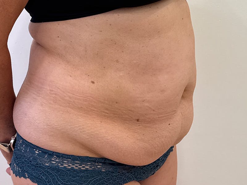 Tummy Tuck Before & After Gallery - Patient 103670 - Image 3