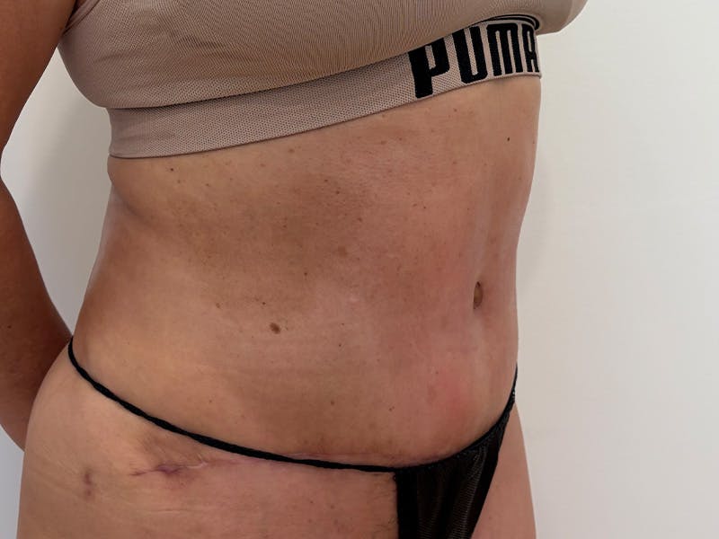 Tummy Tuck Before & After Gallery - Patient 103670 - Image 4