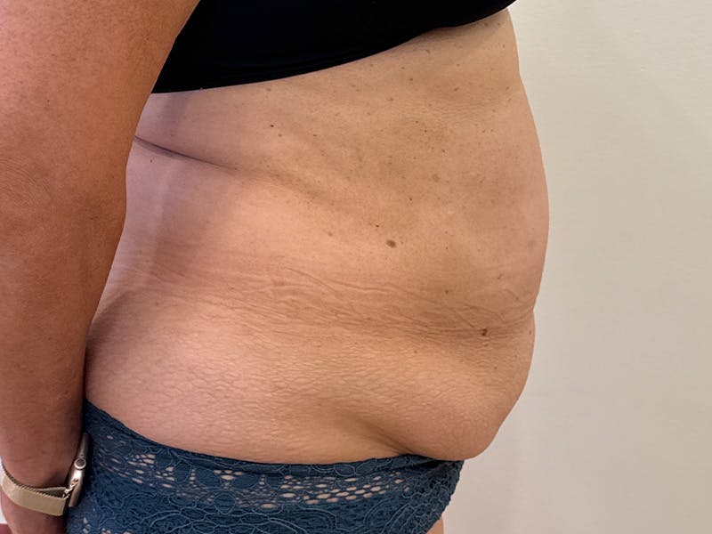 Tummy Tuck Before & After Gallery - Patient 103670 - Image 5