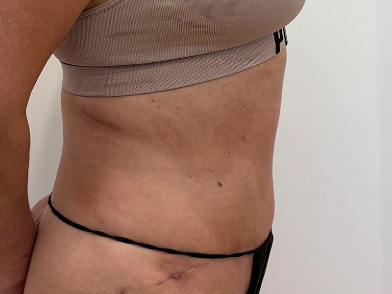 Tummy Tuck Before & After Gallery - Patient 103670 - Image 6