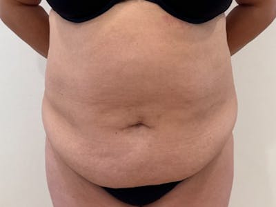 Tummy Tuck Before & After Gallery - Patient 391578 - Image 1