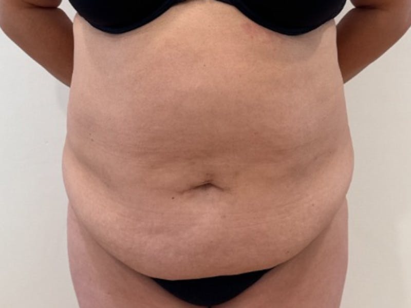 Tummy Tuck Before & After Gallery - Patient 391578 - Image 1