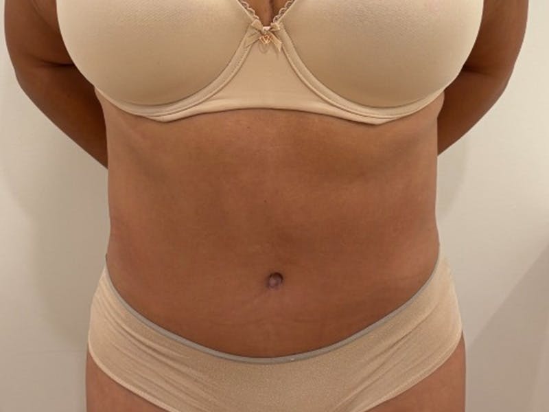 Tummy Tuck Before & After Gallery - Patient 391578 - Image 2