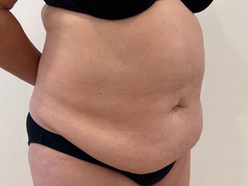 Tummy Tuck Before & After Gallery - Patient 391578 - Image 3