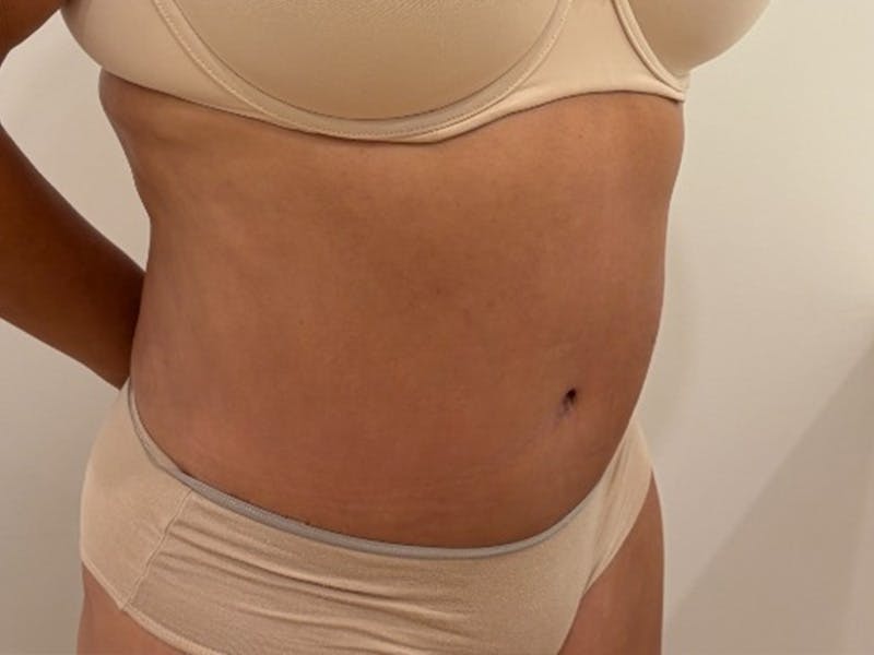 Tummy Tuck Before & After Gallery - Patient 391578 - Image 4