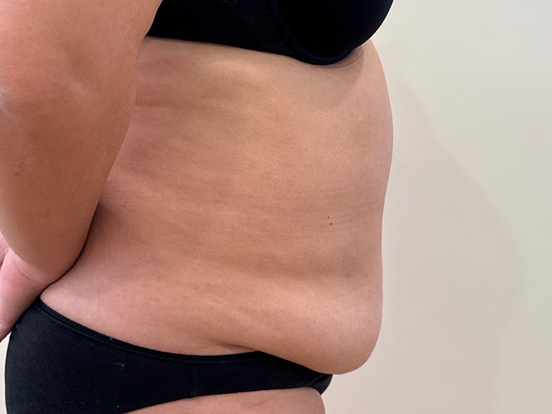 Tummy Tuck Before & After Gallery - Patient 391578 - Image 5