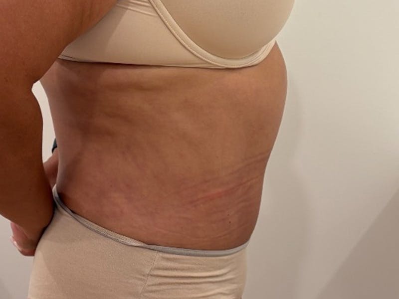 Tummy Tuck Before & After Gallery - Patient 391578 - Image 6