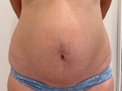 Tummy Tuck Before & After Gallery - Patient 603122 - Image 1