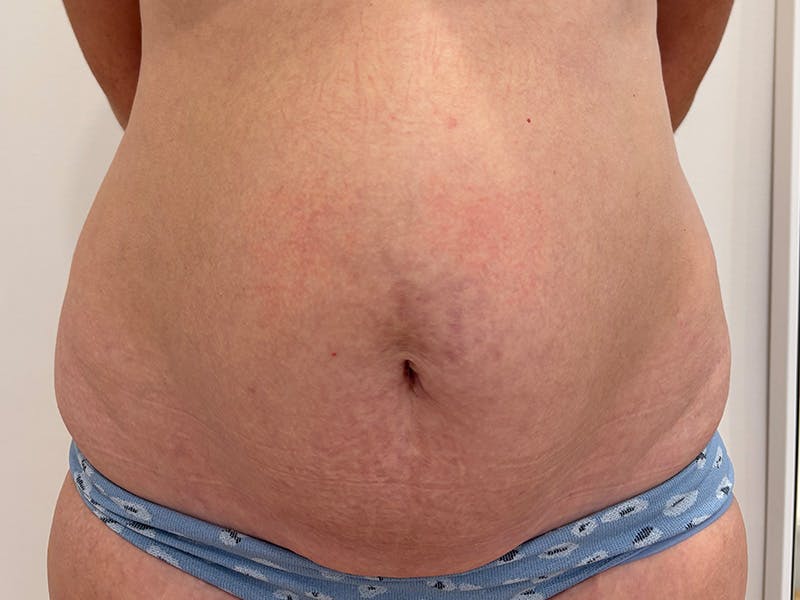 Tummy Tuck Before & After Gallery - Patient 603122 - Image 1