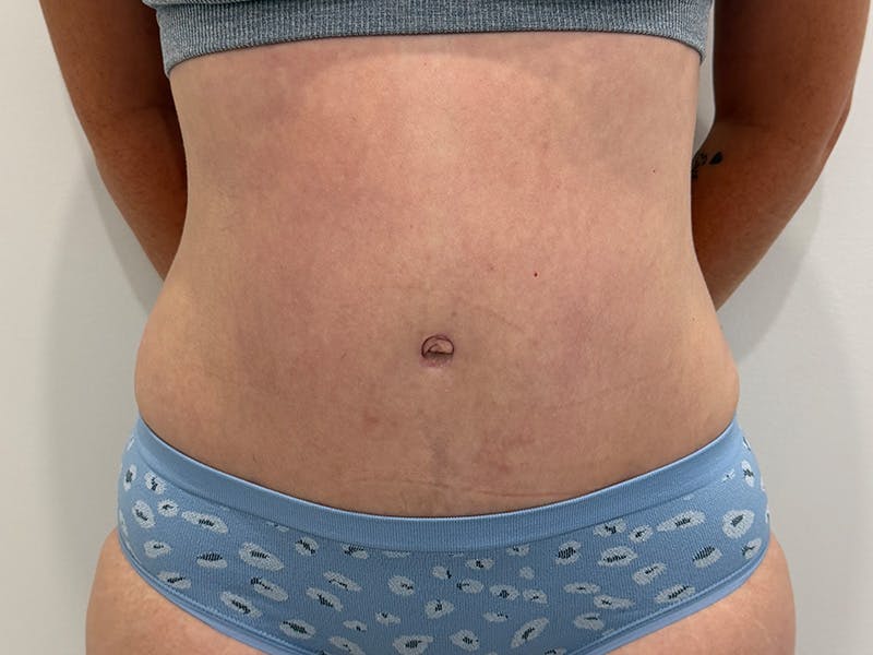 Tummy Tuck Before & After Gallery - Patient 603122 - Image 2