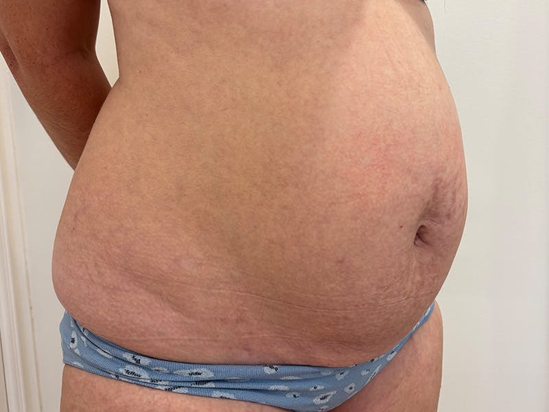 Tummy Tuck Before & After Gallery - Patient 603122 - Image 3