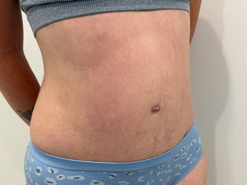 Tummy Tuck Before & After Gallery - Patient 603122 - Image 4