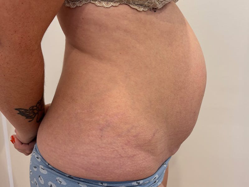 Tummy Tuck Before & After Gallery - Patient 603122 - Image 5