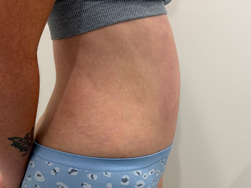 Tummy Tuck Before & After Gallery - Patient 603122 - Image 6