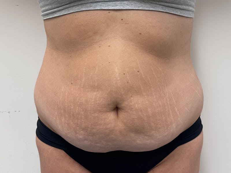 Tummy Tuck Before & After Gallery - Patient 459517 - Image 1