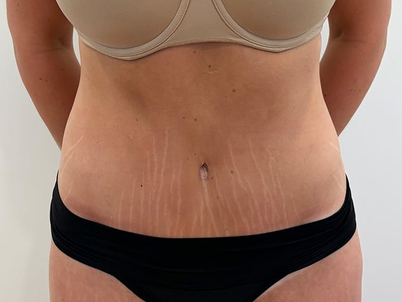 Tummy Tuck Before & After Gallery - Patient 459517 - Image 2