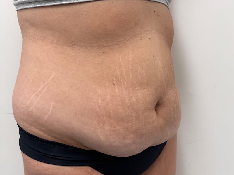 Tummy Tuck Before & After Gallery - Patient 459517 - Image 3
