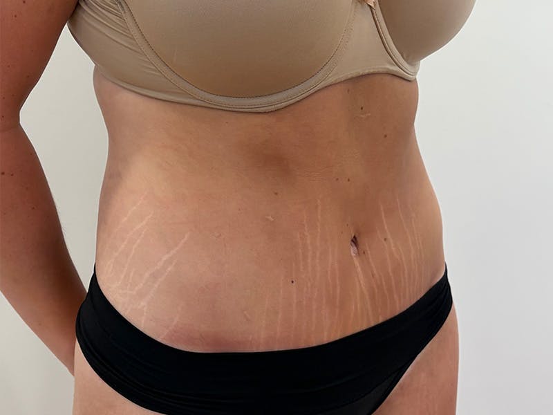 Tummy Tuck Before & After Gallery - Patient 459517 - Image 4