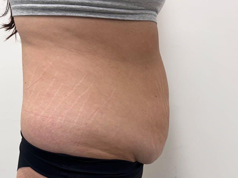 Tummy Tuck Before & After Gallery - Patient 459517 - Image 5
