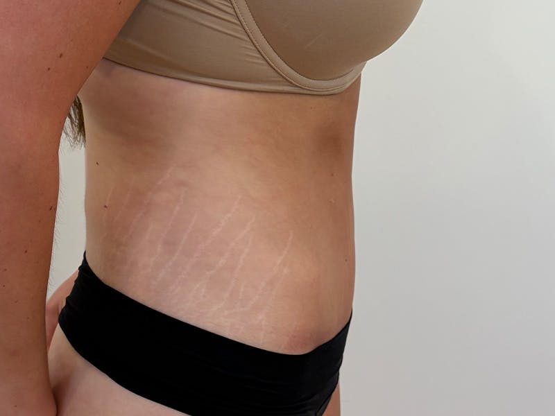 Tummy Tuck Before & After Gallery - Patient 459517 - Image 6