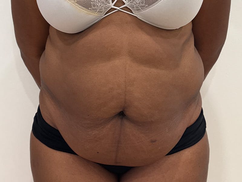 Tummy Tuck Before & After Gallery - Patient 197656 - Image 1
