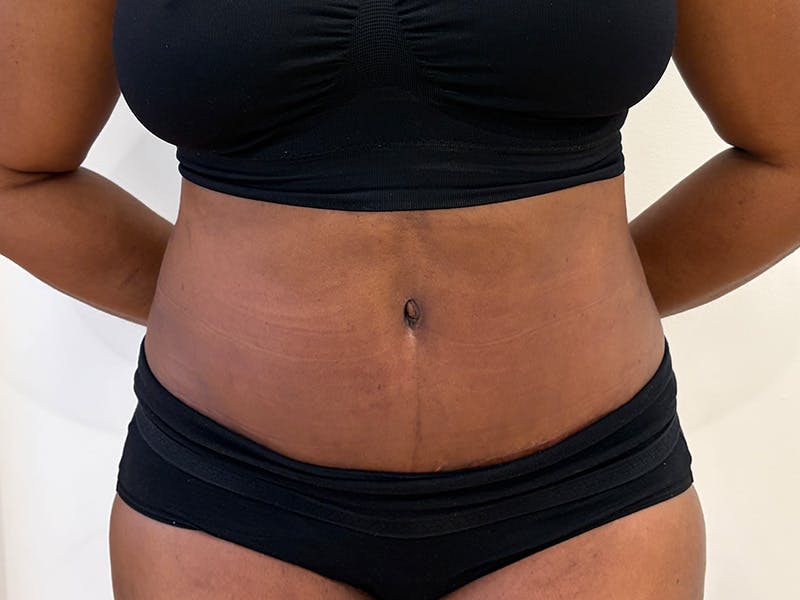 Tummy Tuck Before & After Gallery - Patient 197656 - Image 2