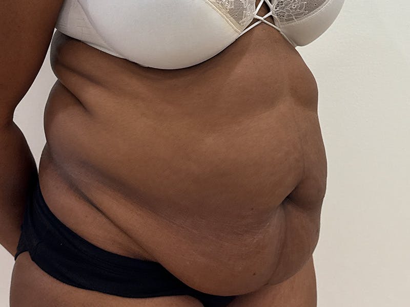 Tummy Tuck Before & After Gallery - Patient 197656 - Image 3