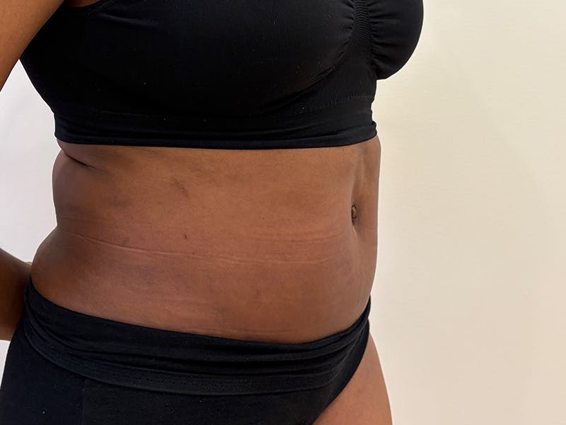Tummy Tuck Before & After Gallery - Patient 197656 - Image 4