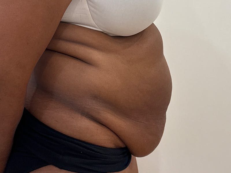 Tummy Tuck Before & After Gallery - Patient 197656 - Image 5