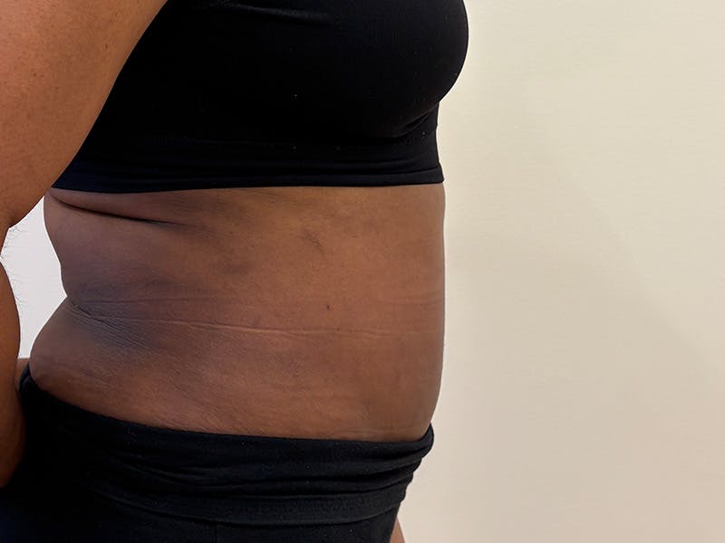 Tummy Tuck Before & After Gallery - Patient 197656 - Image 6