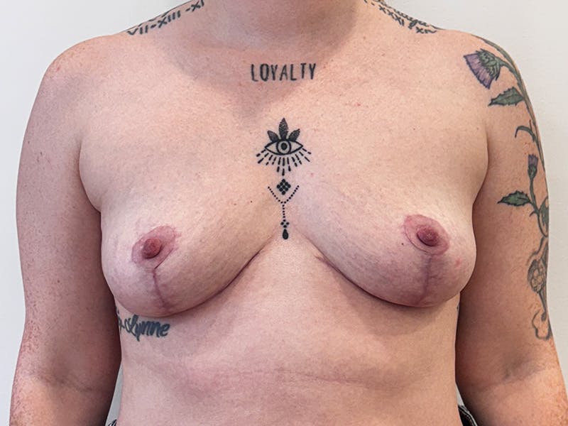 Explant with Breast Lift Before & After Gallery - Patient 265773 - Image 2