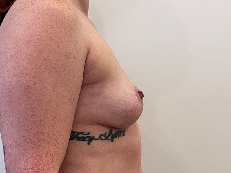 Explant with Breast Lift Before & After Gallery - Patient 265773 - Image 6