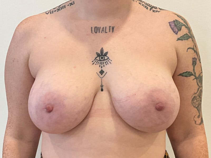Explant with Breast Lift Before & After Gallery - Patient 265773 - Image 1