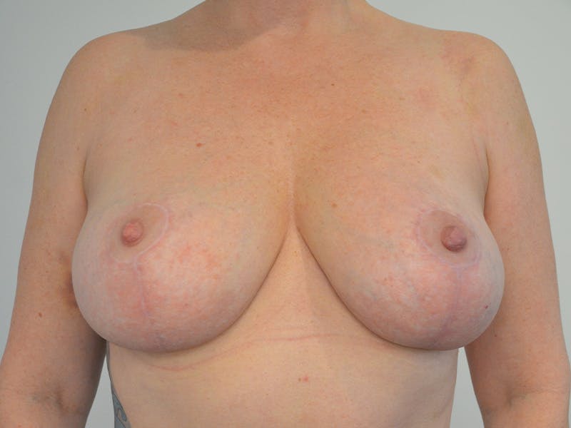 Explant with Breast Lift Before & After Gallery - Patient 211616 - Image 2