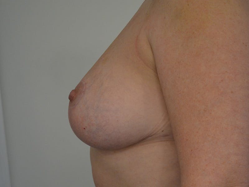 Explant with Breast Lift Before & After Gallery - Patient 211616 - Image 6