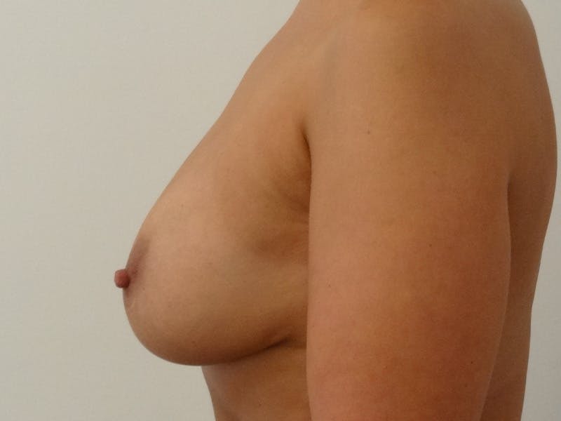 Explant with Breast Lift Before & After Gallery - Patient 371460 - Image 5