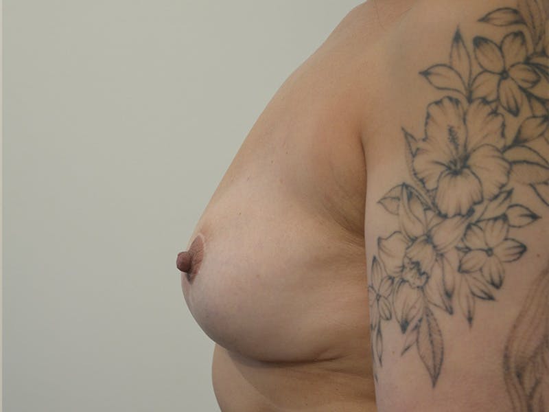 Explant with Breast Lift Before & After Gallery - Patient 371460 - Image 6